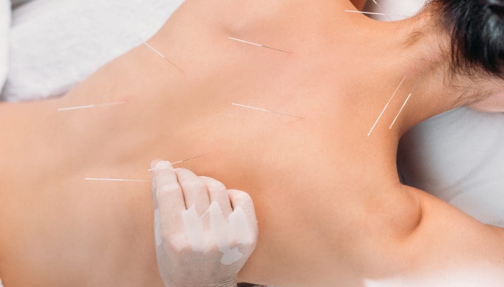Acupuncturist targeting pressure points for anxiety, including Yintang and Spirit Gate, to promote the use of calming self-care items like fidget rings and wellness tools in the background.